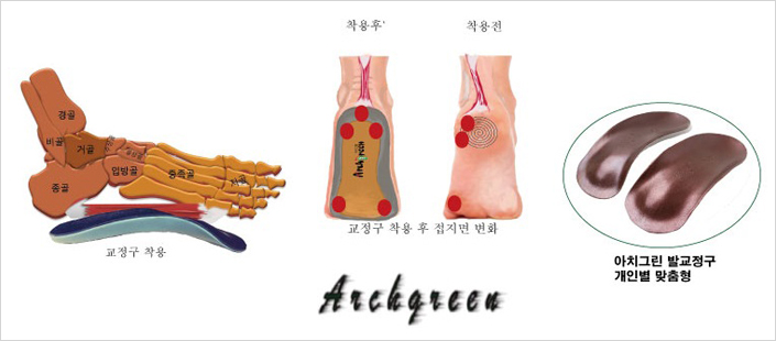 교정구의 역할/중력의 효과적인 분배